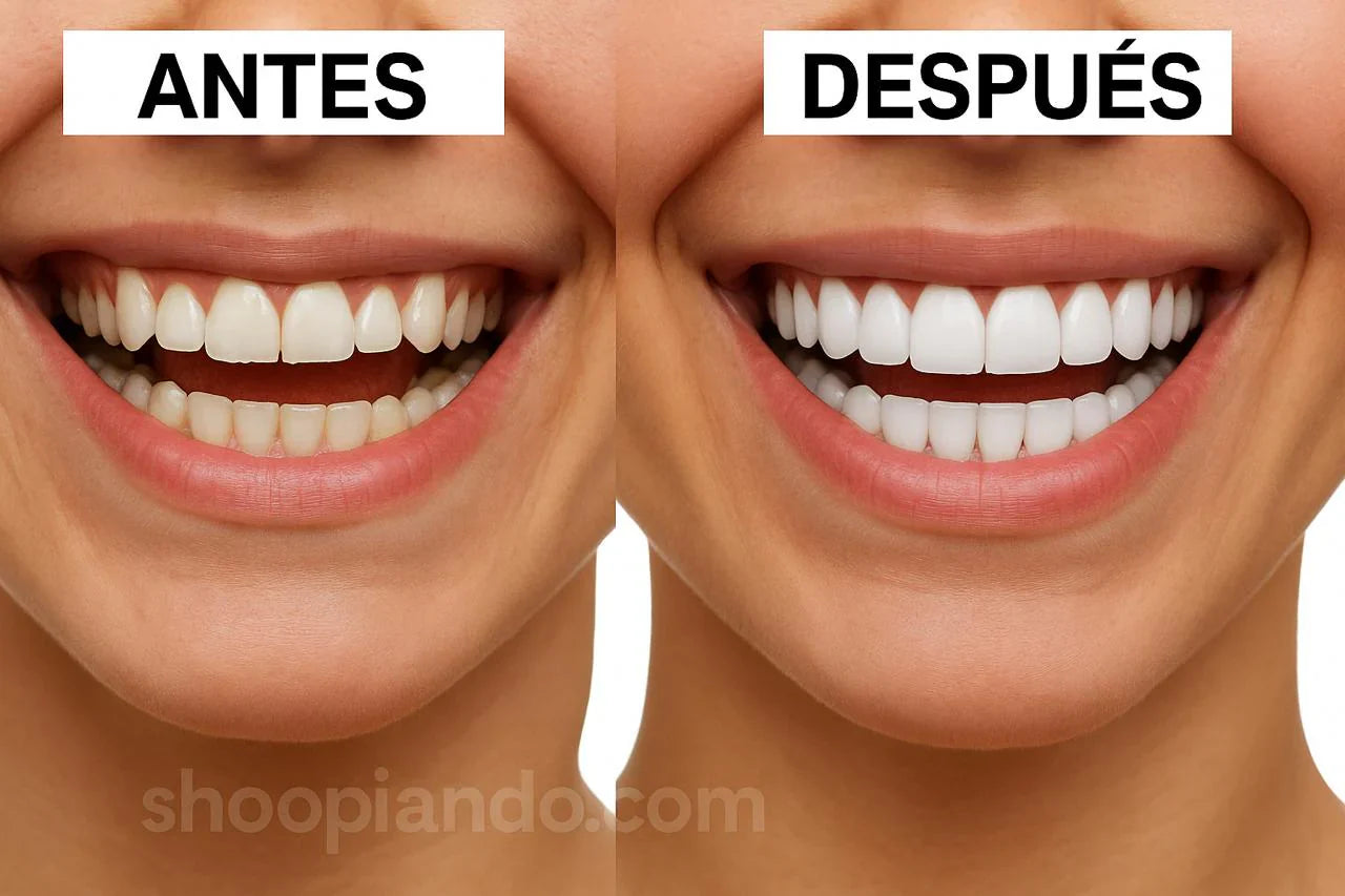 🦷 CARILLAS DENTALES - Descubre el poder de una sonrisa blanca + 3 REGALOS